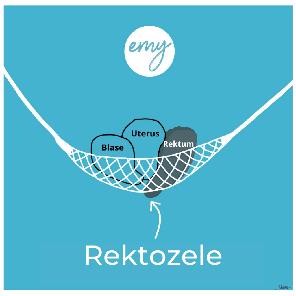 Abbildung Rektozele - Organvorfall