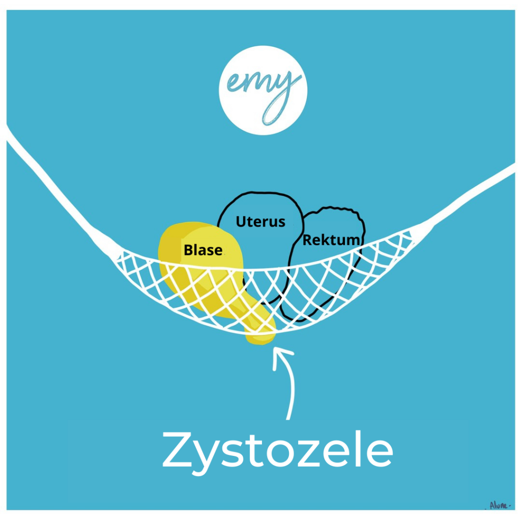 Zystozele Schema