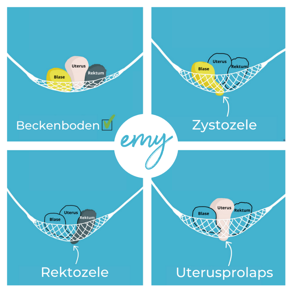 verschiedene Formen eines Prolaps