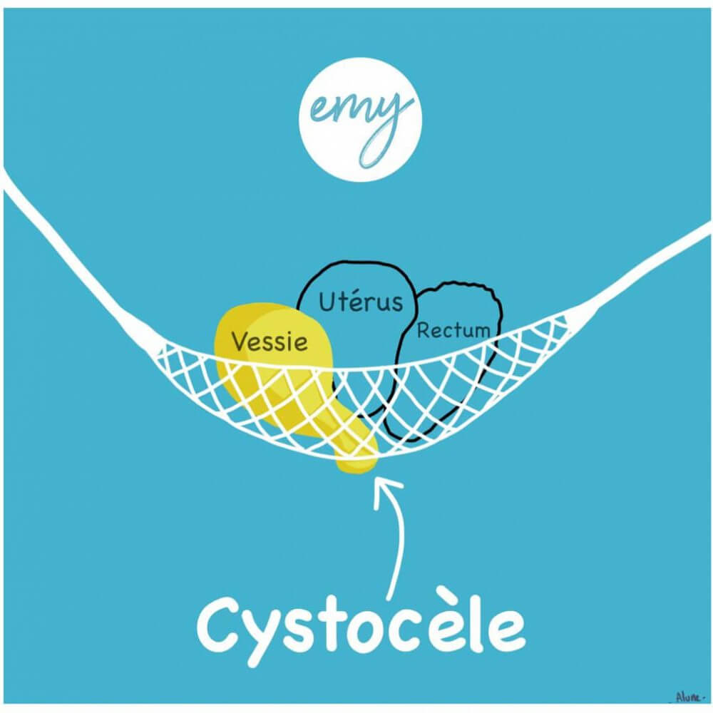 La solution Emy évite la cystocèle 