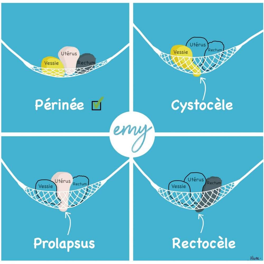 Périnée Prolapsus rectocèle cystocèle la solution Emy