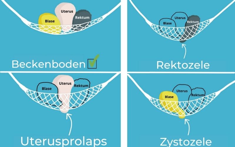 Formen Prolaps Zystozele Rektozele Gebaermuttersenkung